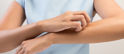 A woman with allergic contact dermatitis scratching her arm